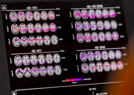 Mudança de hábitos ajuda a diminuir probabilidade de Alzheimer, mesmo com risco genético